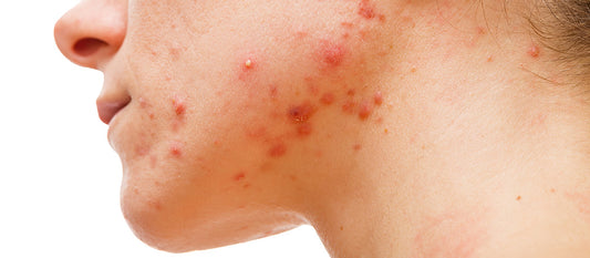 Keratosis Pilaris and Rosacea