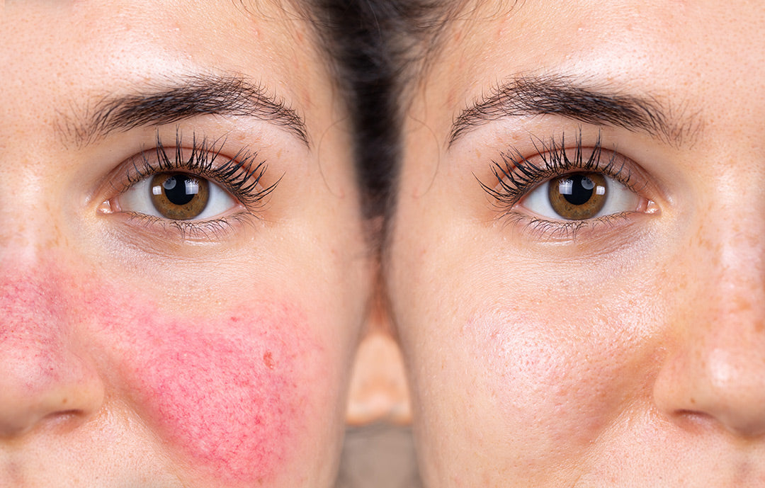 Female facial redness before-and-after comparison