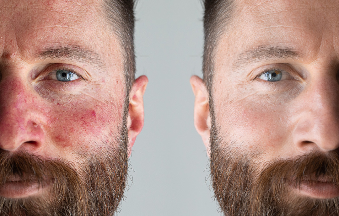 Male facial redness before-and-after comparison